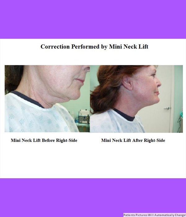 Correction Performed By Mini-Neck Lift, Right Side View Cost is $3200.00