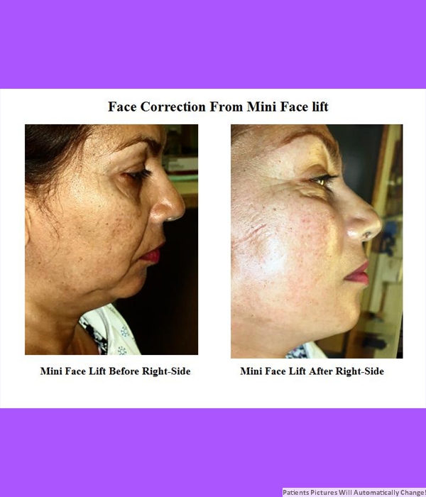 Correction Performed By Mini Face Lift, Right Side View Cost is $3,200.00